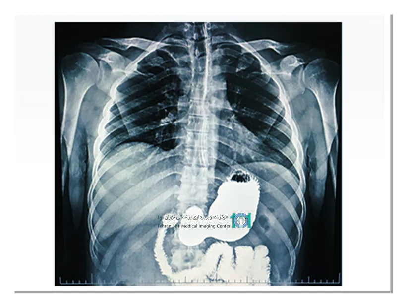 پرتونگاری معده: تشخیص سریع و دقیق مشکلات گوارشی 3 عوارض پرتونگاری معده
