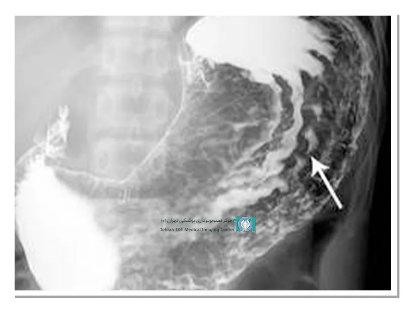 پرتونگاری معده: تشخیص سریع و دقیق مشکلات گوارشی 4 آمادگی های قبل از مراجعه انجام پرتونگاری