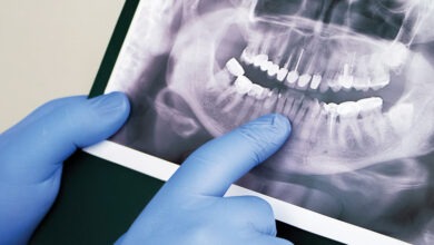 عکس OPG دندان چیست و چه کاربردی دارد؟