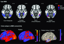 تصویر برداری تشدید مغناطیسی کاربردی (fMRI) اف ام آر آی چیست؟