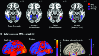تصویر برداری تشدید مغناطیسی کاربردی (fMRI) اف ام آر آی چیست؟
