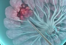 بیوپسی تحت گاید سونوگرافی پستان چیست؟