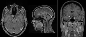 MRI غده هیپوفیز