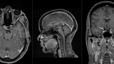 MRI غده هیپوفیز