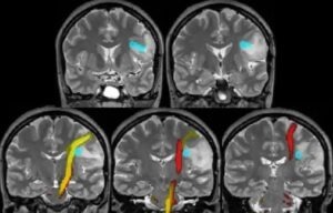 اف ام آر آی مغز (fMRI) یا تصویر برداری تشدید مغناطیسی چیست؟