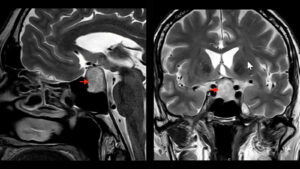 انجام MRI غده هیپوفیز در مرکز تصویربرداری تهران 101