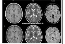 ام آر آی تومور مغزی