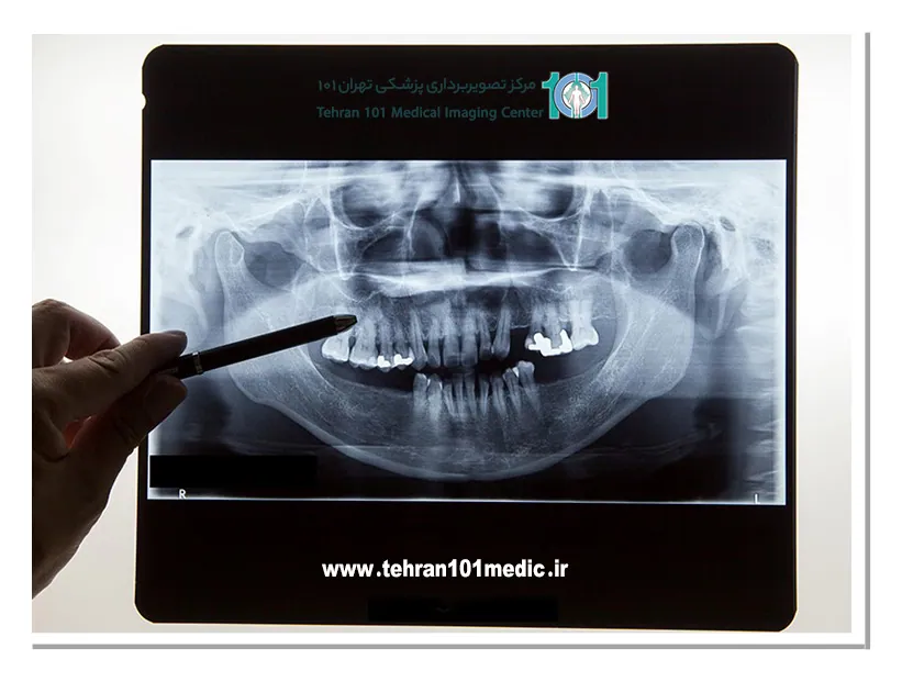 رادیوگرافی خارج دهانی