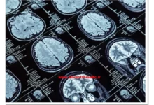 آیا ام آر آی مغز خطرناک است
