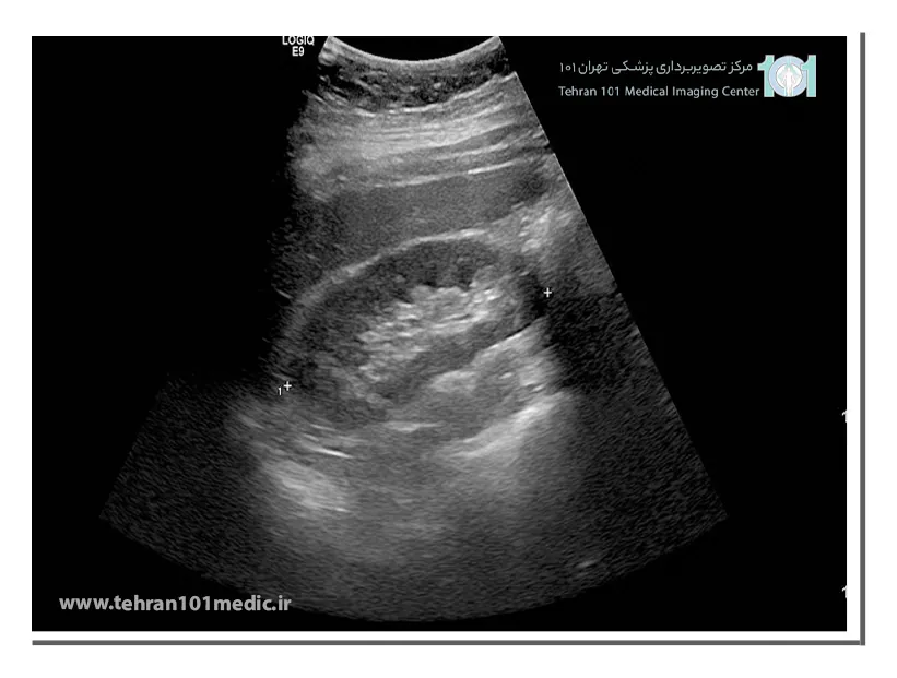 روشی دقیق برای بررسی سلامت کلیهها 2 سونوگرافی کلیه