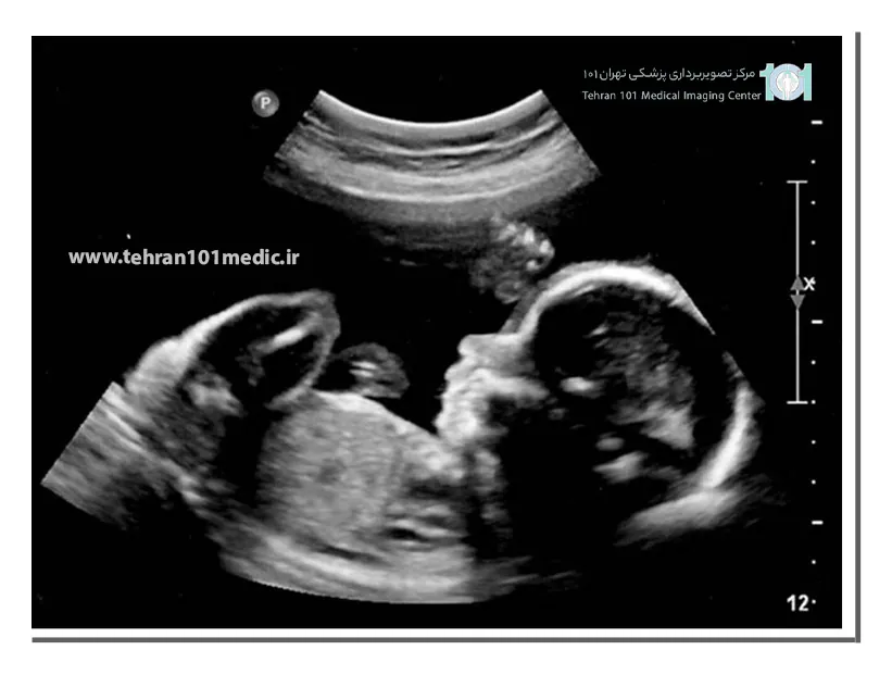 علت اشتباه سونوگرافی در تشخیص جنسیت جنین دختر