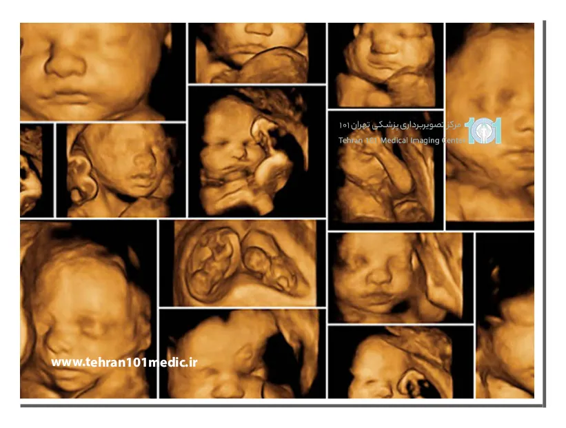 سونوگرافی آنومالی: تشخیص زود هنگام مشکلات جنینی 6 تفسیر اندازه گیریهای سونوگرافی آنومالی