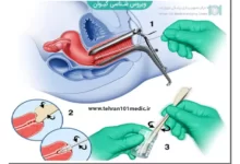 بیوپسی زگیل تناسلی