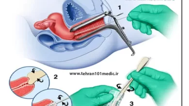 بیوپسی زگیل تناسلی چگونه انجام میشود؟ 5 بیوپسی زگیل تناسلی