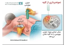 بیوپسی کلیه