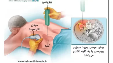 بیوپسی کلیه؛ راهکاری دقیق برای تشخیص و درمان بیماریهای کلیوی 7 بیوپسی کلیه