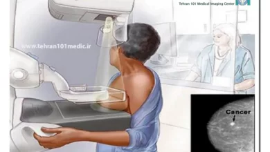 ماموگرافی مشکوک آیا سرطان است؟ 4 ماموگرافی مشکوک