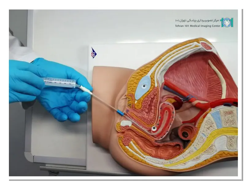 عوارض نمونه برداری از رحم