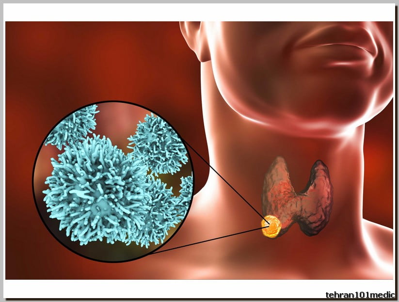 ? سونوگرافی تیروئید و پاراتیروئید در 2024 2 سونوگرافی تیروئید و پاراتیروئید چیست