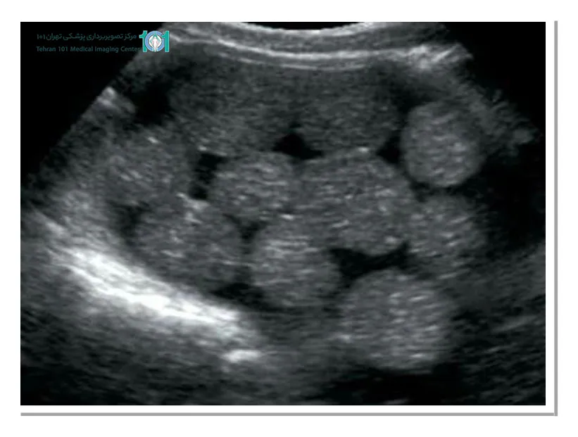 اکوژن در سونوگرافی چیست و چه مفهومی دارد؟ 4 پولیپ رحمی چیست