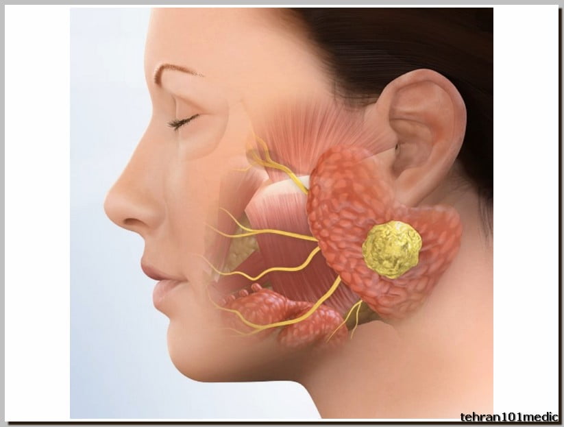 سونوگرافی غدد بزاقی چیست