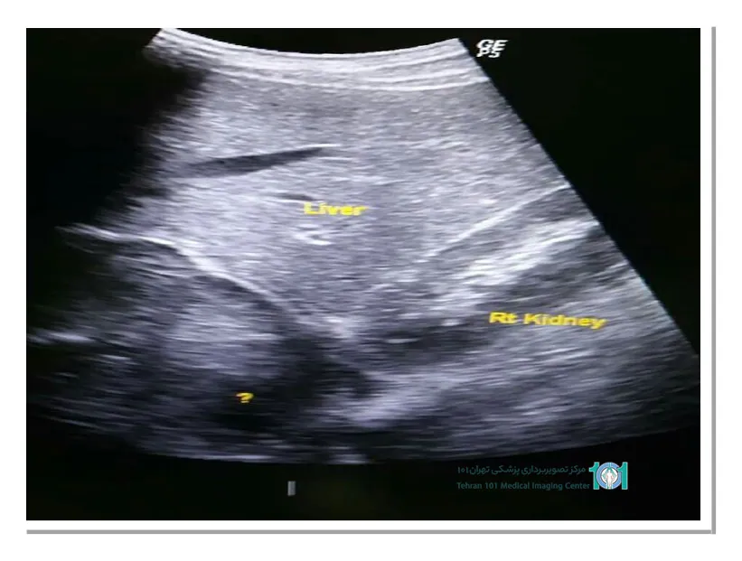 اکوژن در سونوگرافی چیست و چه مفهومی دارد؟ 3 آیا وجود توده اکوژن در قلب جنین نگران کننده است