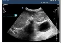 اکوژن در سونوگرافی چیست