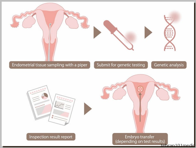 نمونه برداری از رحم: تشخیص دقیق، درمان قطعی 4 Sampling of the uterus