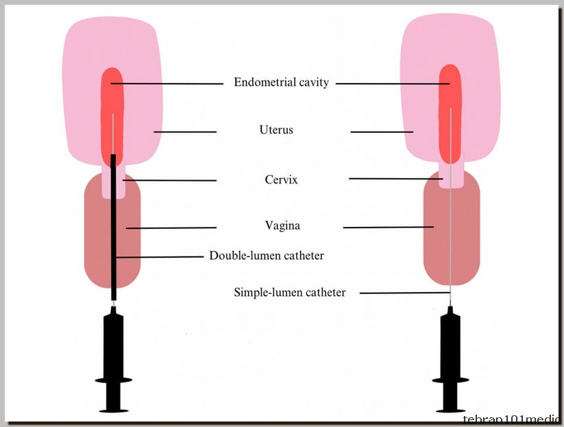 نمونه برداری از رحم: تشخیص دقیق، درمان قطعی 5 Sampling of the uterus 2