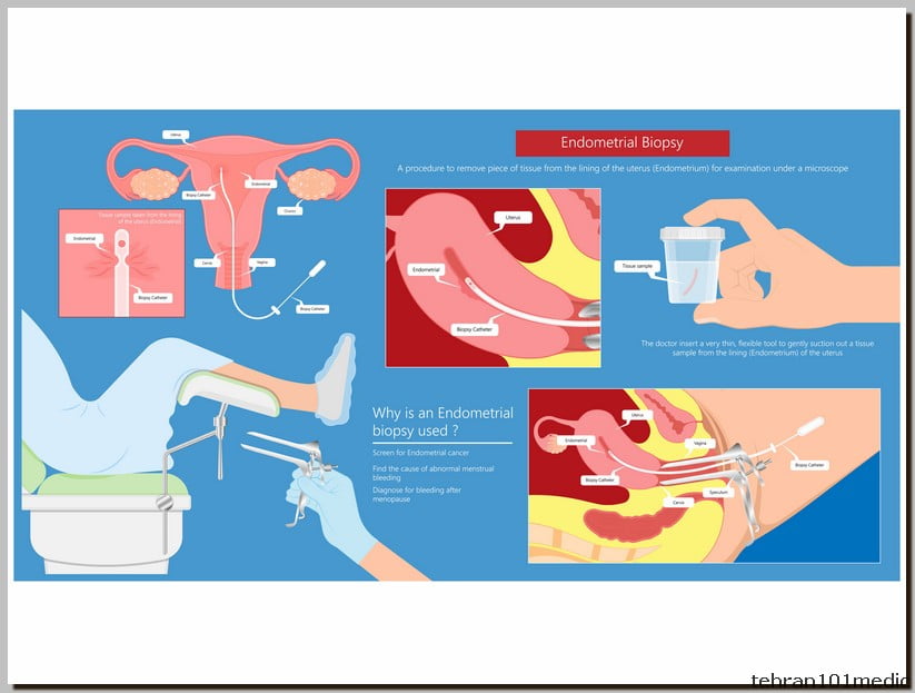 نمونه برداری از رحم: تشخیص دقیق، درمان قطعی 3 Sampling of the uterus 3