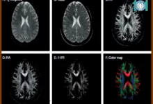 تصویربرداری دیفیوژن تنسور چیست
