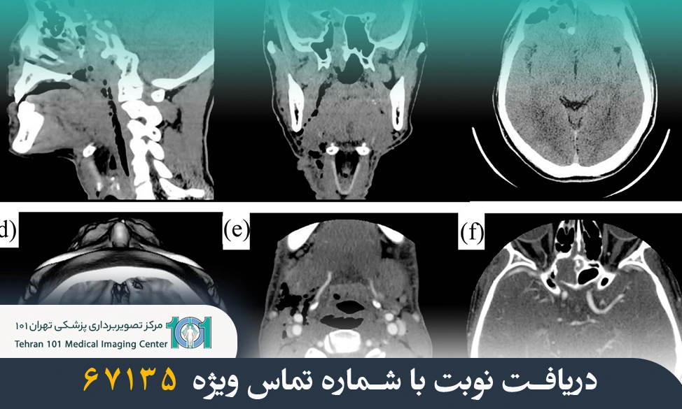 سی تی اسکن صورت و سینوس چیست و چرا انجام میشود؟ بررسی کامل کاربردها و دلایل آن 3 سی تی اسکن صورت و سینوس