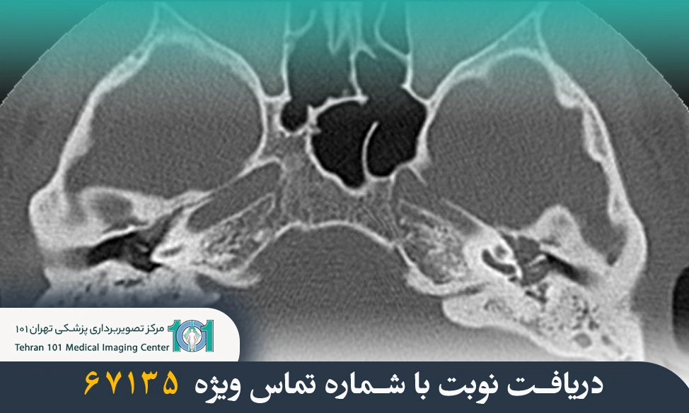 سی تی اسکن گوش چیست و چه کاربردهایی دارد؟ بررسی مراحل انجام و دلایل استفاده از آن 3 سی تی اسکن گوش