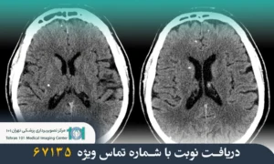 سی تی اسکن مغز چیست و چه کاربردی دارد؟ 8 سی تی اسکن مغز