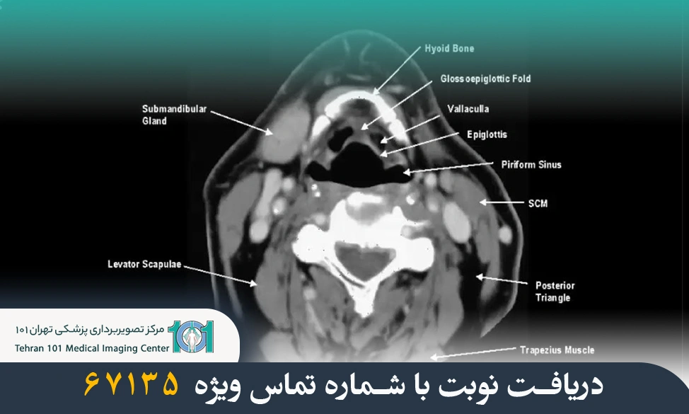سی تی اسکن گردن چیست؟ بررسی کامل کاربردها، دلایل انجام و مراحل آن 3 سی تی اسکن گردن