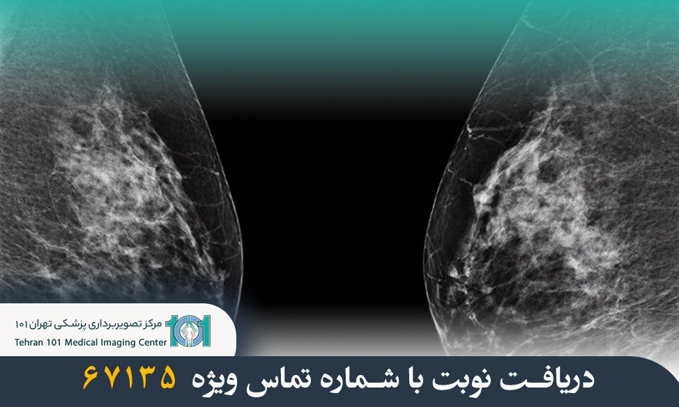 فیبروگلاندولار در ماموگرافی چیست و چه عواملی بر تراکم آن تاثیر میگذارند؟ 3 فیبروگلاندولار در ماموگرافی