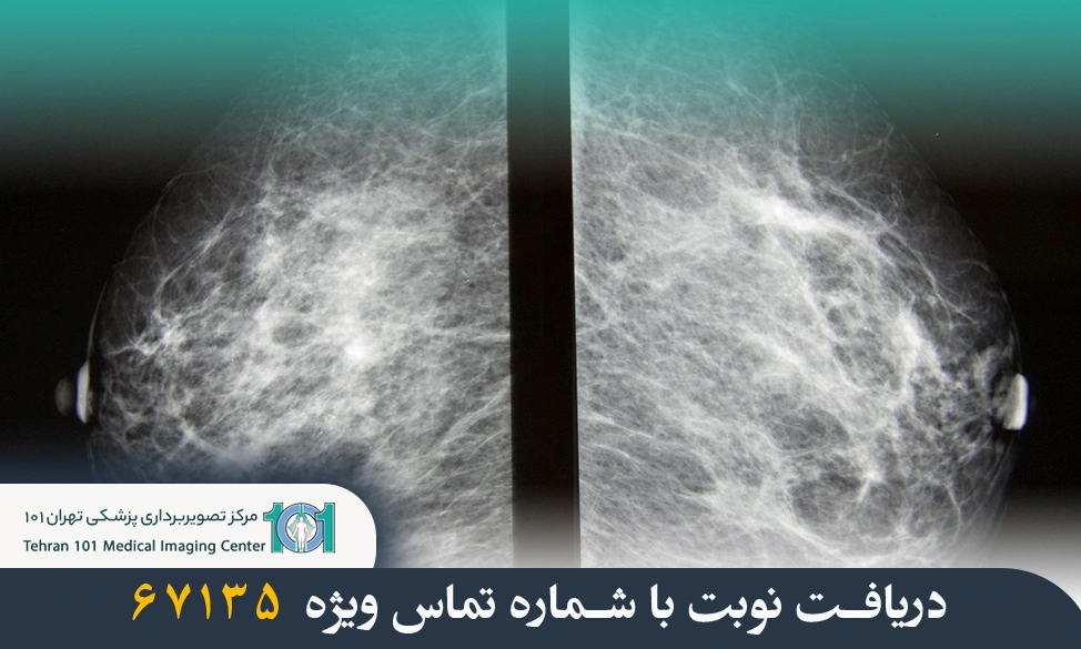 علت سونوگرافی بعد از ماموگرافی 3 علت سونوگرافی بعد از ماموگرافی