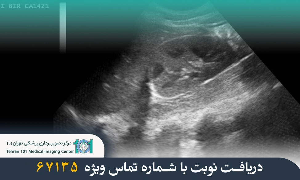 سونوگرافی کلیه و مجاری ادراری چیست و چه کاربردی دارد؟ 6 سونوگرافی کلیه و مجاری ادراری