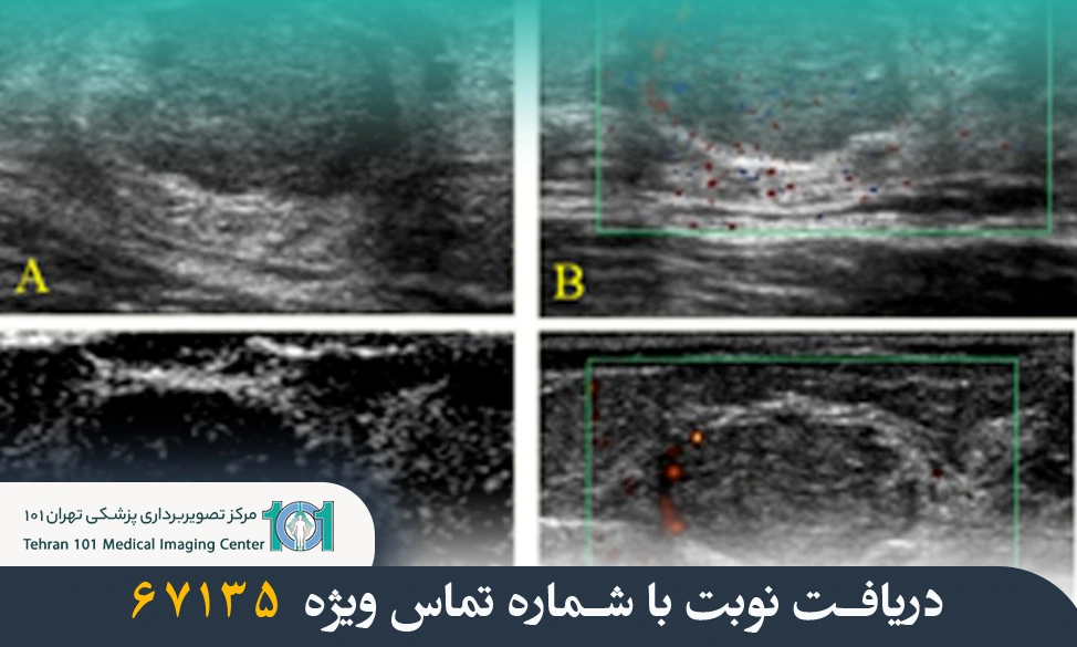 سونوگرافی کالر داپلر سینه