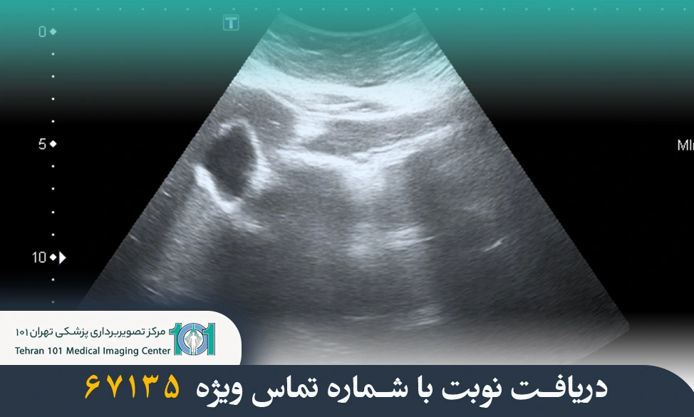 اکوژن در سونوگرافی