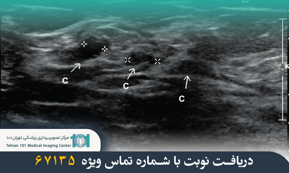 بهترین زمان برای انجام سونوگرافی سینه چه موقع است؟ راهنمای کامل 6 بهترین زمان برای انجام سونوگرافی سینه