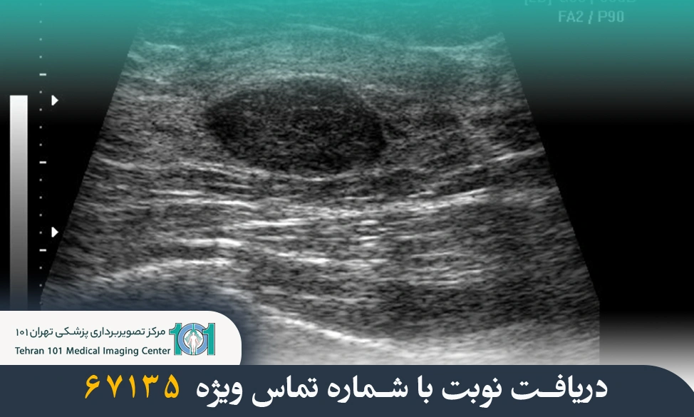 بهترین زمان برای انجام سونوگرافی سینه چه موقع است؟ راهنمای کامل 4 بهترین زمان برای انجام سونوگرافی سینه