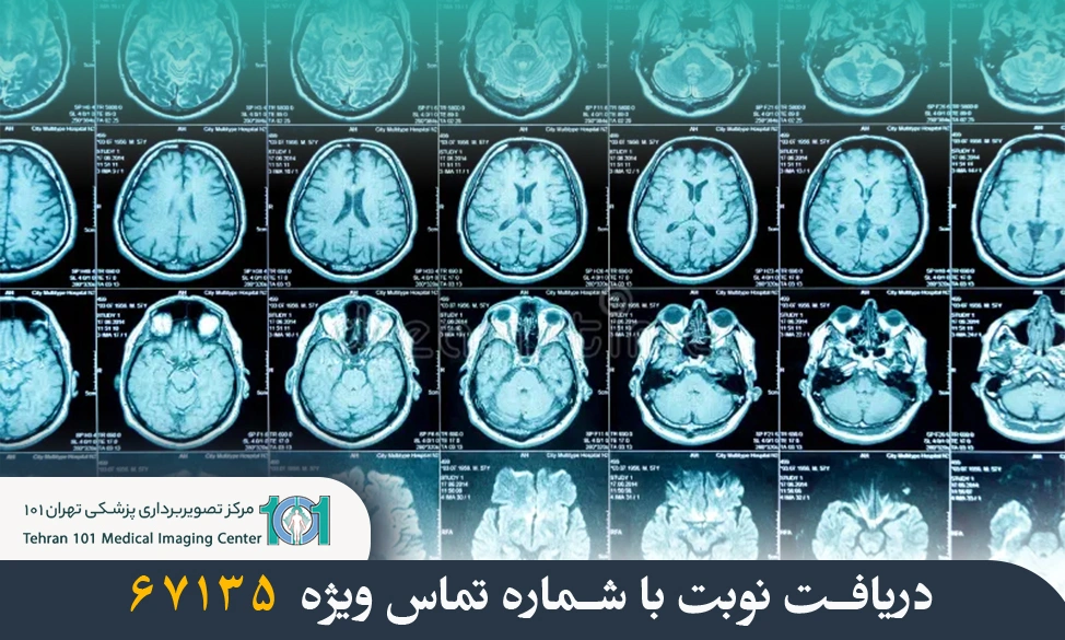 سی تی اسکن مغز چیست و چه کاربردی دارد؟ 7 سی تی اسکن مغز