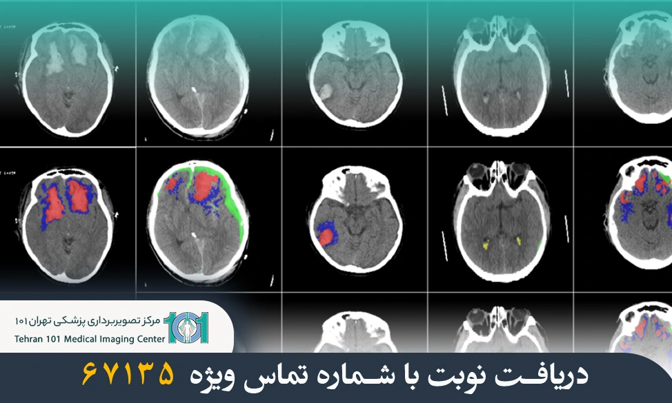 سی تی اسکن مغز چیست و چه کاربردی دارد؟ 9 سی تی اسکن مغز
