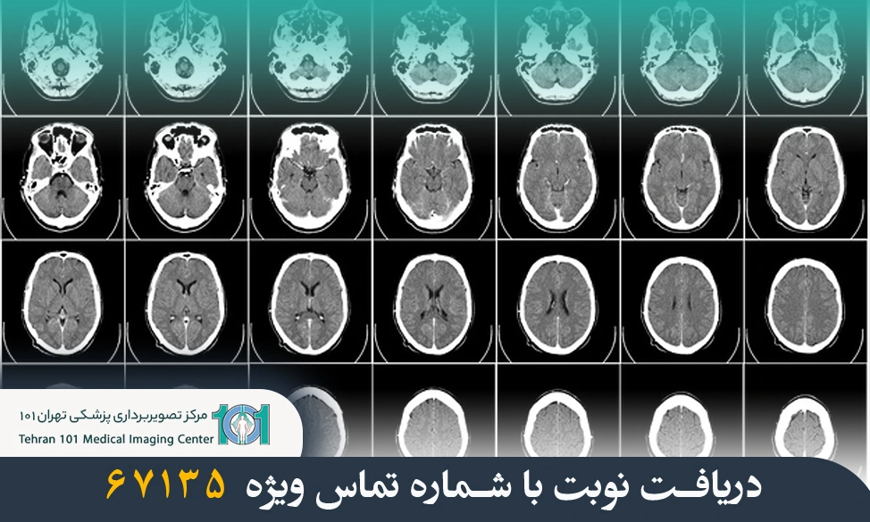 سی تی اسکن مغز چیست و چه کاربردی دارد؟ 5 سی تی اسکن مغز