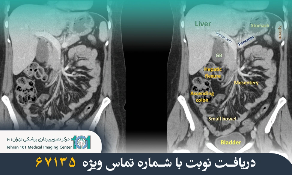 سی تی اسکن شکم و لگن