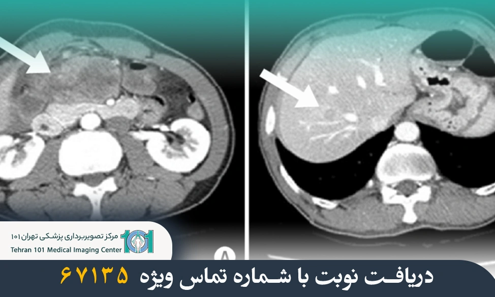 سی تی اسکن با کنتراست تزریقی چیست؟ بررسی نحوه انجام، کاربردها و تفاوتها 2 سی تی اسکن با کنتراست تزریقی