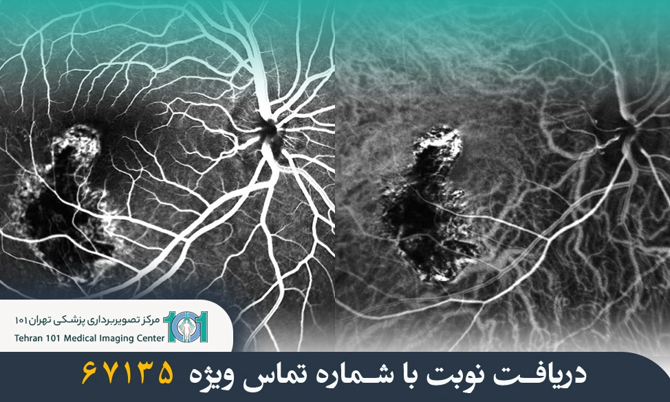 سیتی آنژیو چیست؟ 