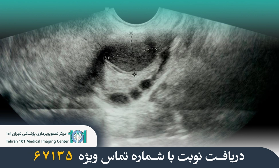 سونوگرافی تنبلی تخمدان